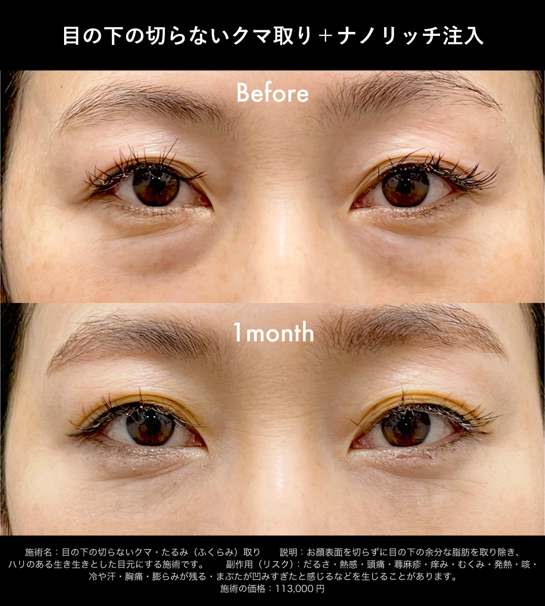 目の下の切らないクマ取り症例1