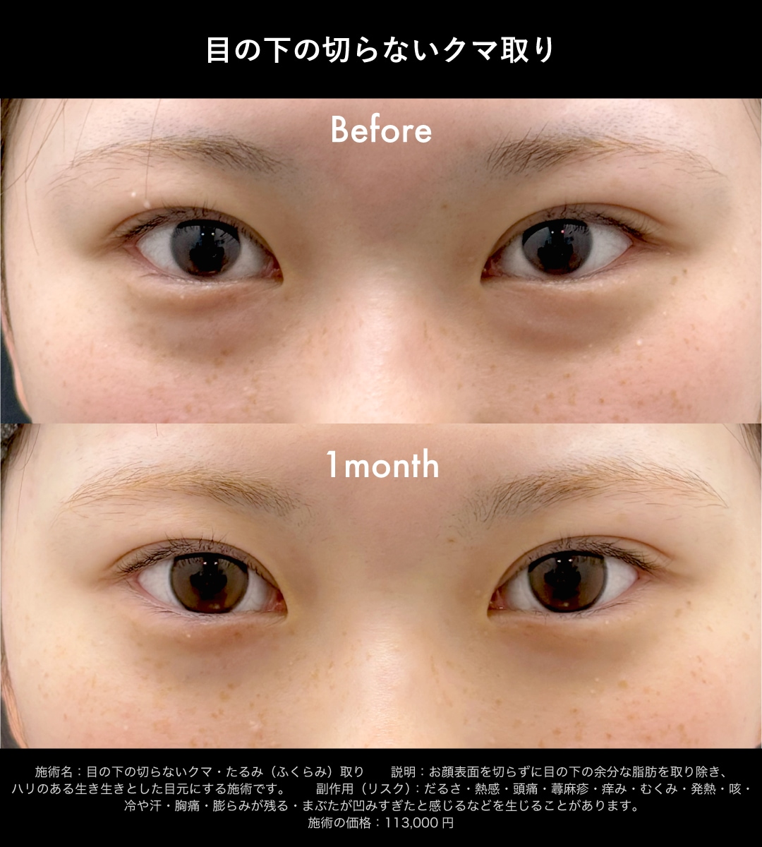 目の下の切らないクマ取り症例2