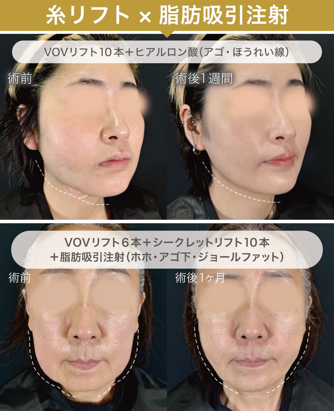 糸リフト×脂肪吸引注射