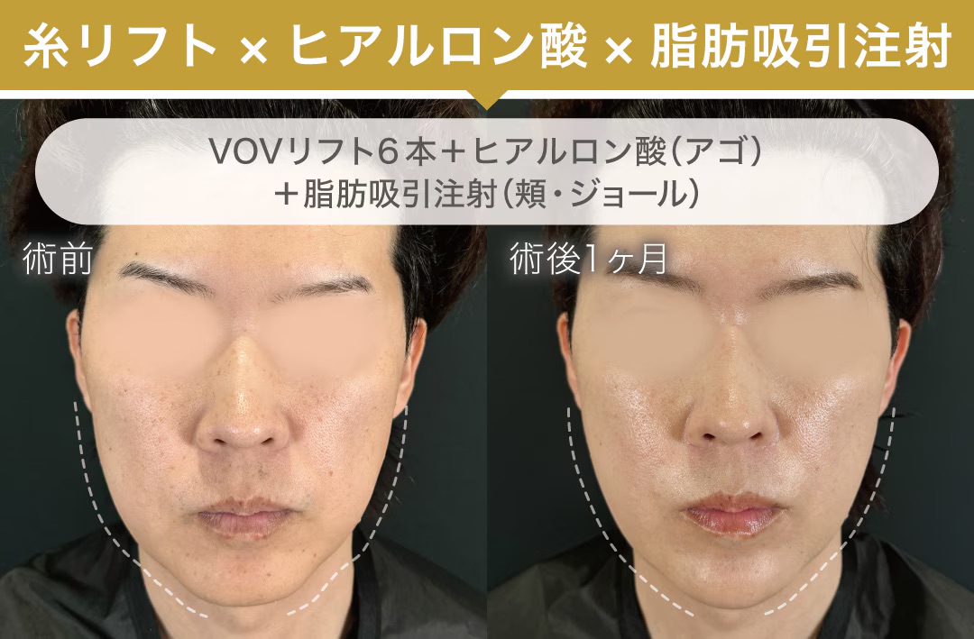 糸リフト×ヒアルロン酸×脂肪吸引注射