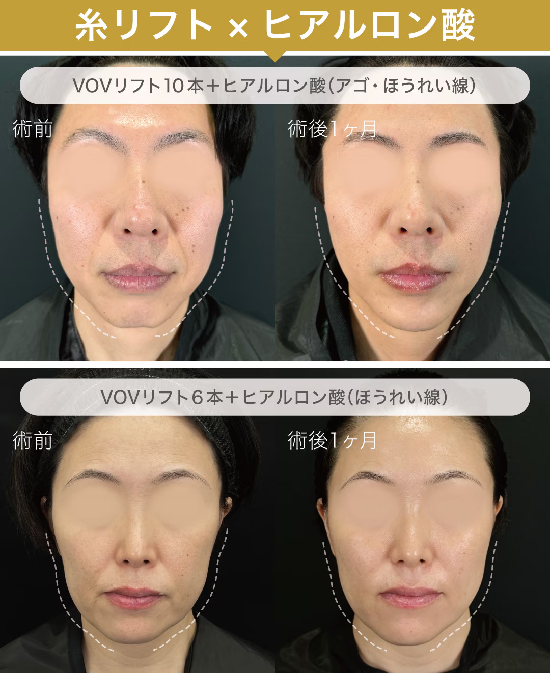 糸リフト×ヒアルロン酸