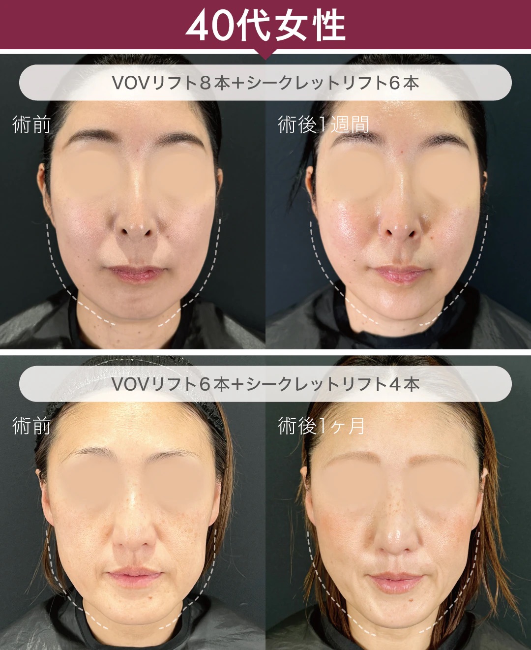 40〜50代症例