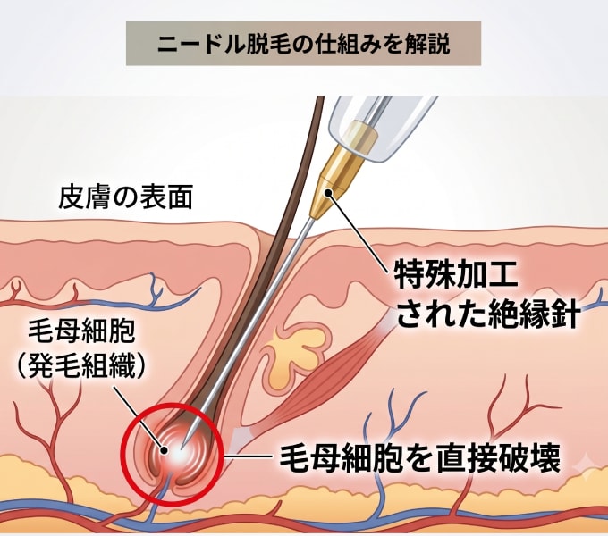 ニードル脱毛とは？