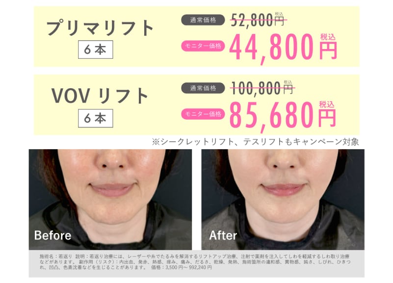 糸リフト価格