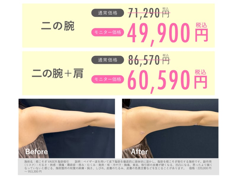 美ボディ脂肪吸引（二の腕）価格