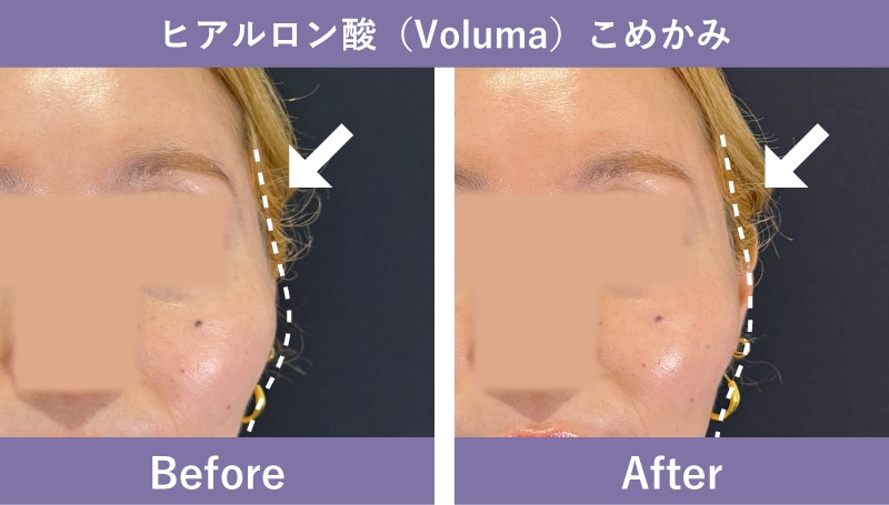 40代女性のヒアルロン酸症例
