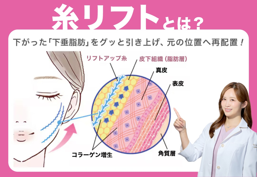 糸リフトとは