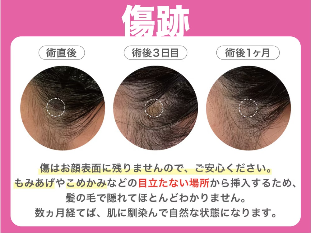 傷跡