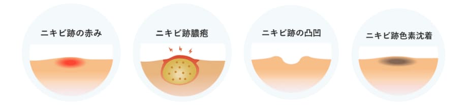 なんでニキビってできるの？？