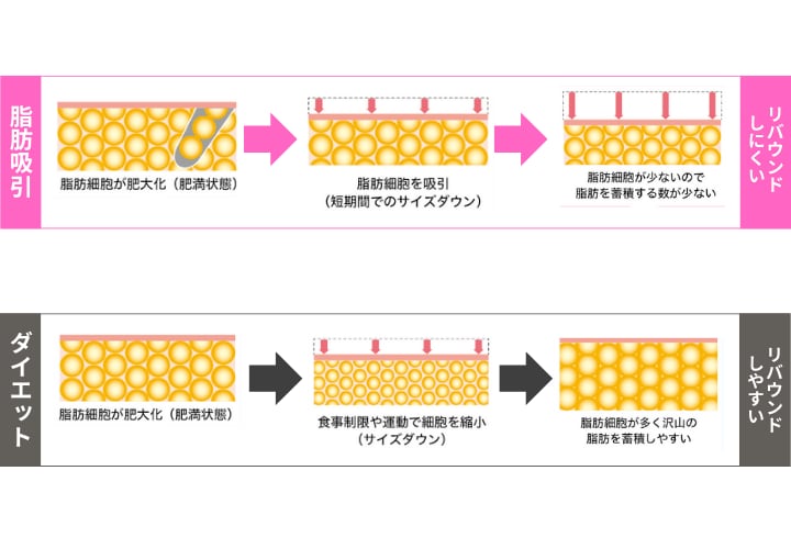 脂肪吸引でとれた脂肪を再利用しませんか？