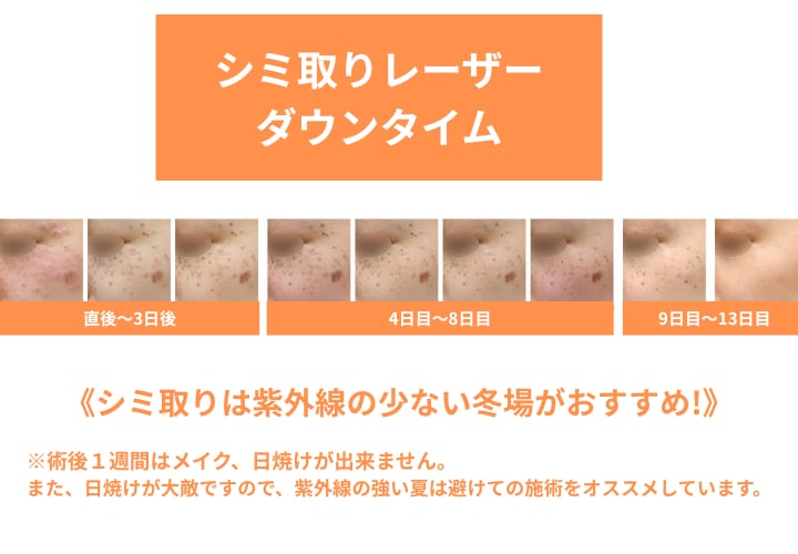 シミ取りレーザー(しみ取りレーザー10、シミ取り放題)