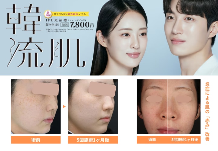 フォトダブル・フォトトリプル(IPL光治療)
