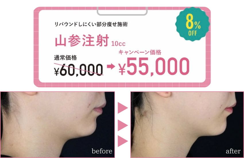 脂肪溶解注射