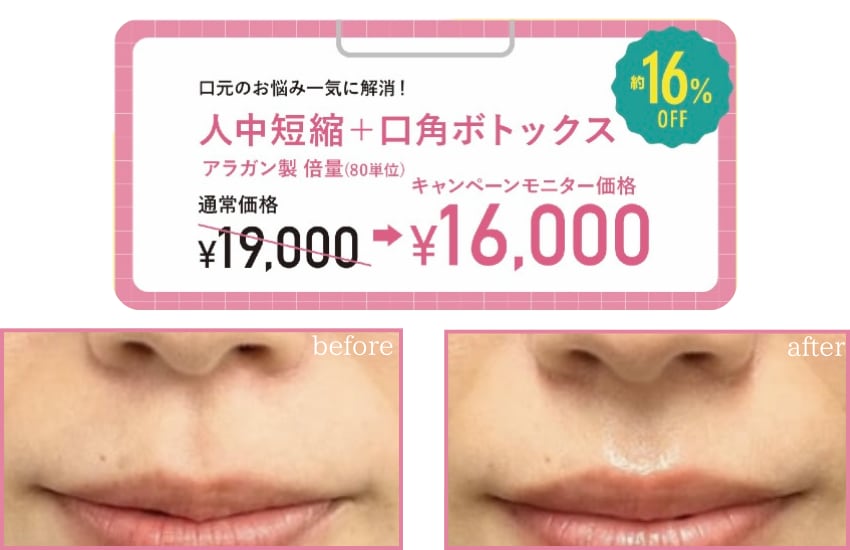人中短縮＋口角ボトックス
