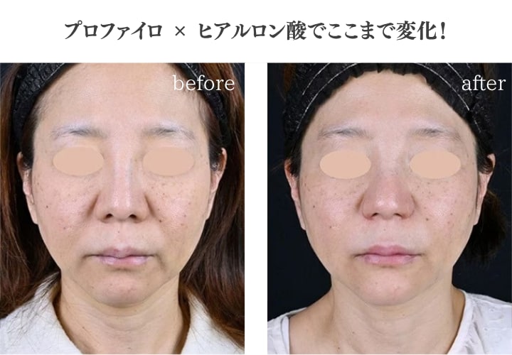 《プロファイロ(2㏄)(顔または首または手の甲)》