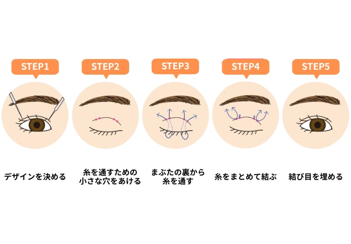 切らない二重術