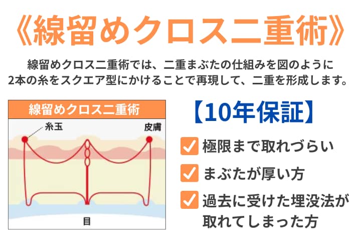 《線留めクロス二重術》