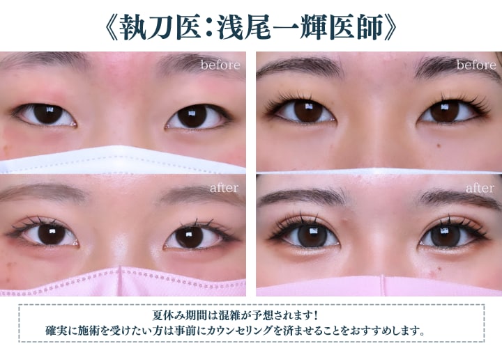 福井で二重ならDr.浅尾にお任せ！