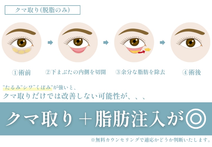 シワやくぼみが強い方は脂肪注入した方がキレイに仕上がる！✨