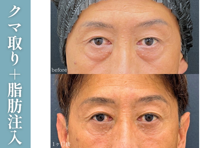 【症例】50代〜：クマ取り＋脂肪注入