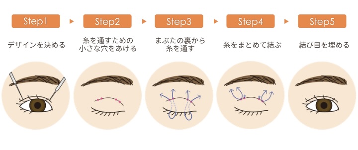 二重整形「埋没法」とは？<br />
