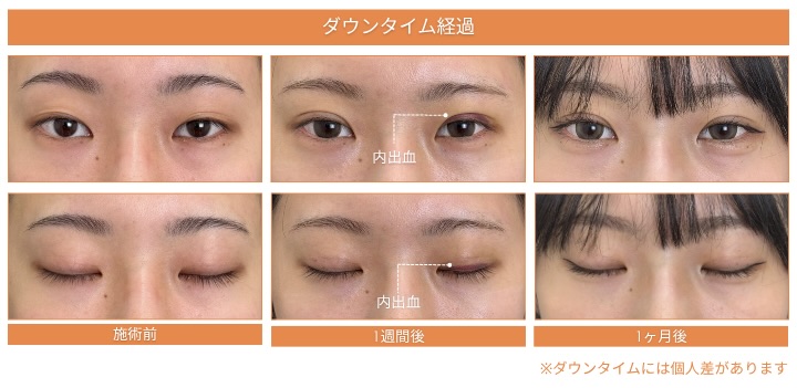 二重整形「埋没法」の主なダウンタイムと期間<br />
