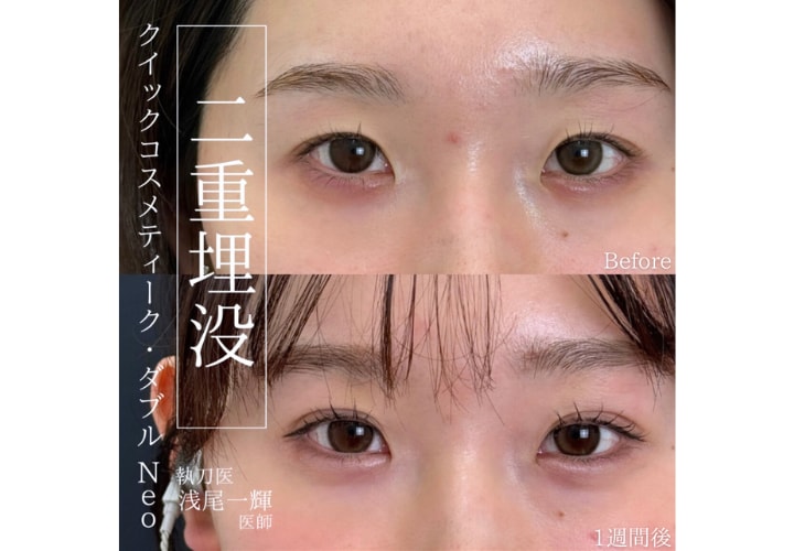 二重整形埋没法<br />
「クイックコスメティーク法」