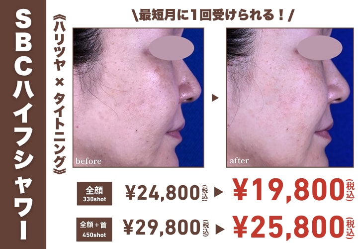 SBCハイフシャワー