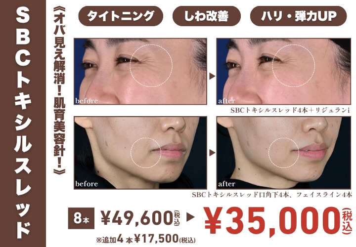 SBCトキシルスレッド