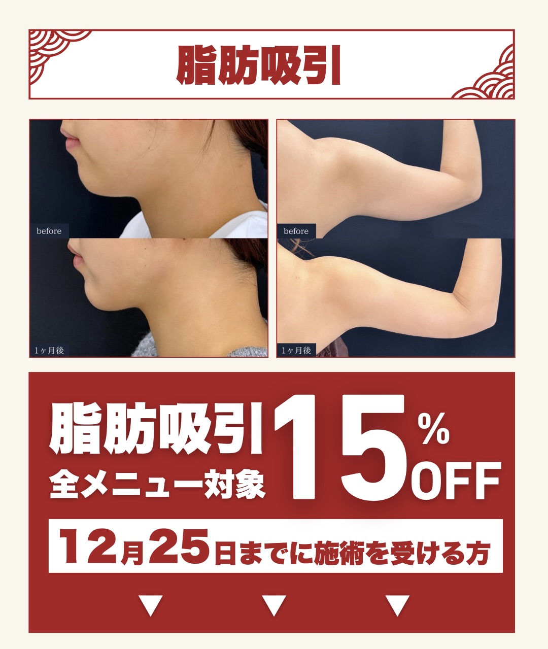 ❄️脂肪吸引❄️