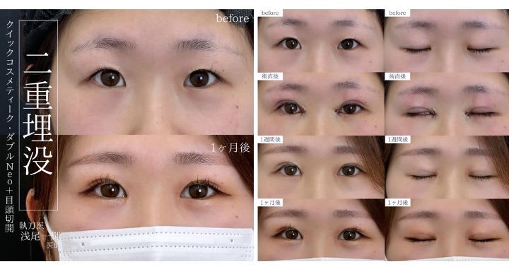 蒙古ひだがある方、左右の目のバランスを整えたい方におすすめ！✨