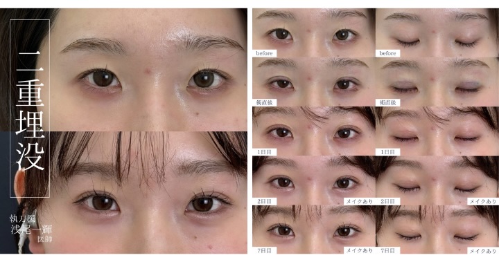 湘南史上最も腫れづらい埋没法！✨<br />
今ならモニター審査優遇中！💖