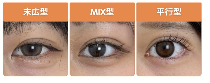 二重整形の埋没法で作れるデザインは、大きく分けると末広型、MIX型、平行型の3種類があります。