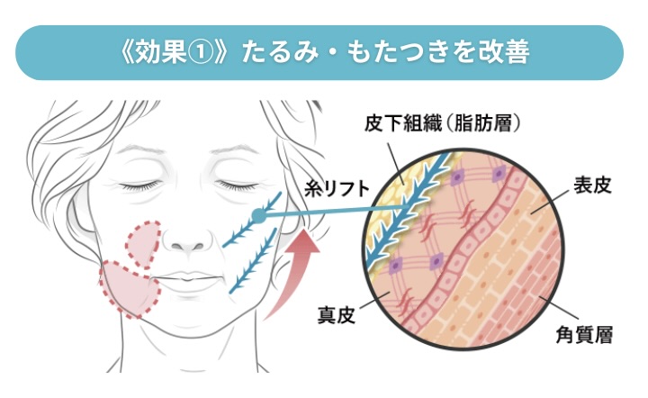 効果① たるみ・もたつきを改善<br />
