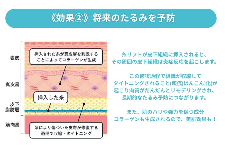 効果② 将来のたるみを予防<br />
