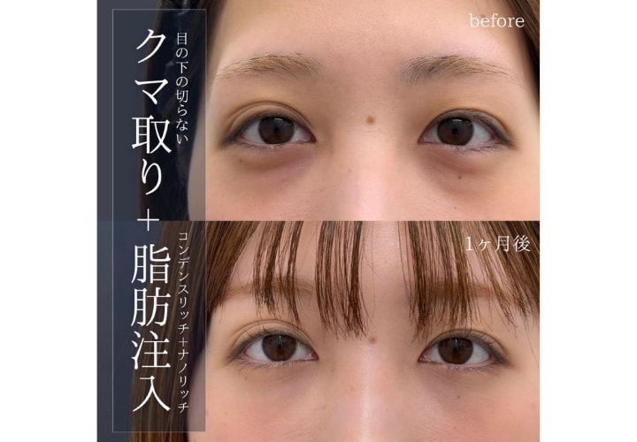 ③クマ取り症例｜20代 女性<br />
