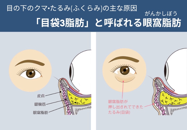 ② クマがセルフケアで消えないのは、<br />
原因の根本に届いていないから。