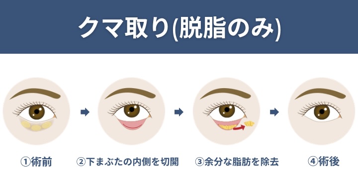 ① 傷跡ゼロで目元スッキリ！一律料金で叶う「切らないクマ取り」<br />
