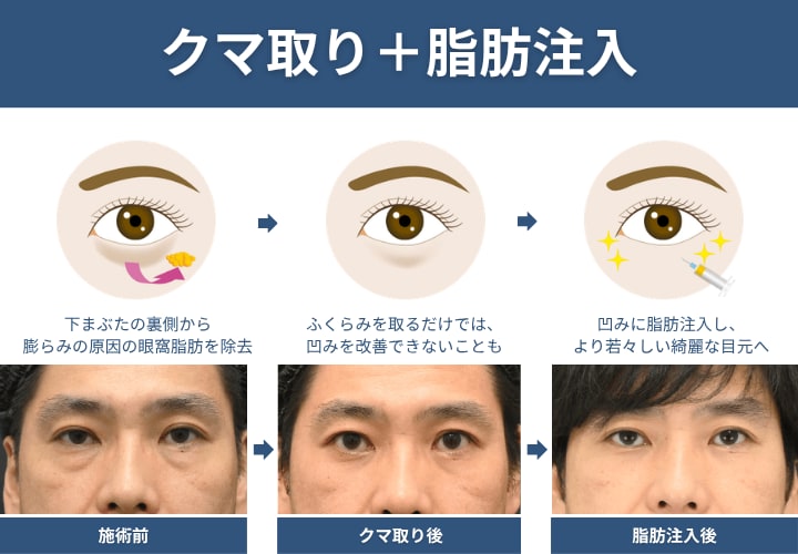 ② 脂肪注入は必要なの？