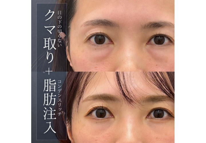 ② クマ取り症例｜40代 女性<br />
