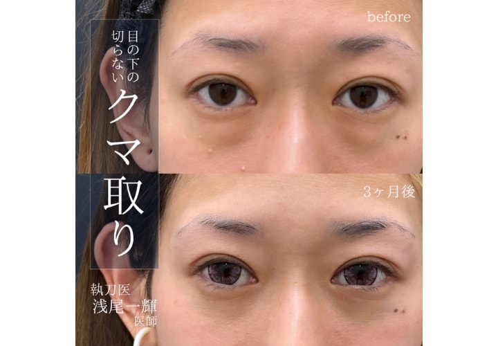 ① クマ取り症例｜30代 女性