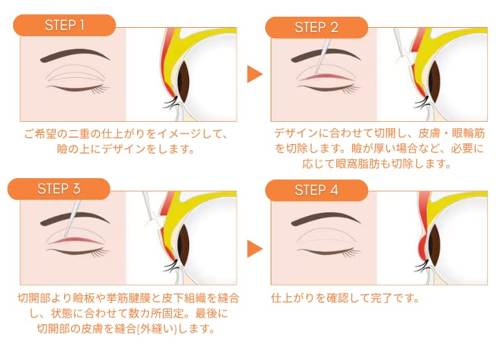 一生モノのラインを作る「切開法」との違いは？<br />
