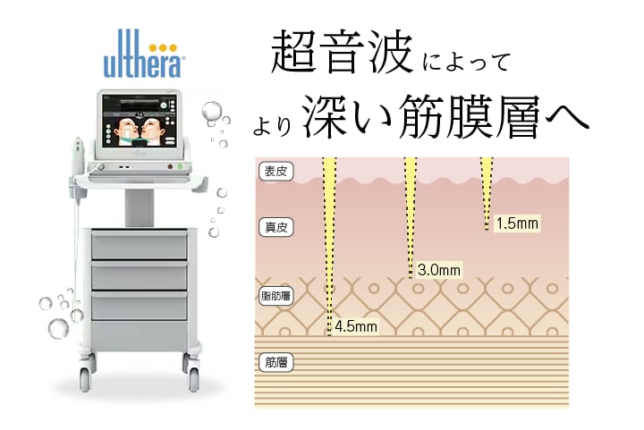 ウルセラって？