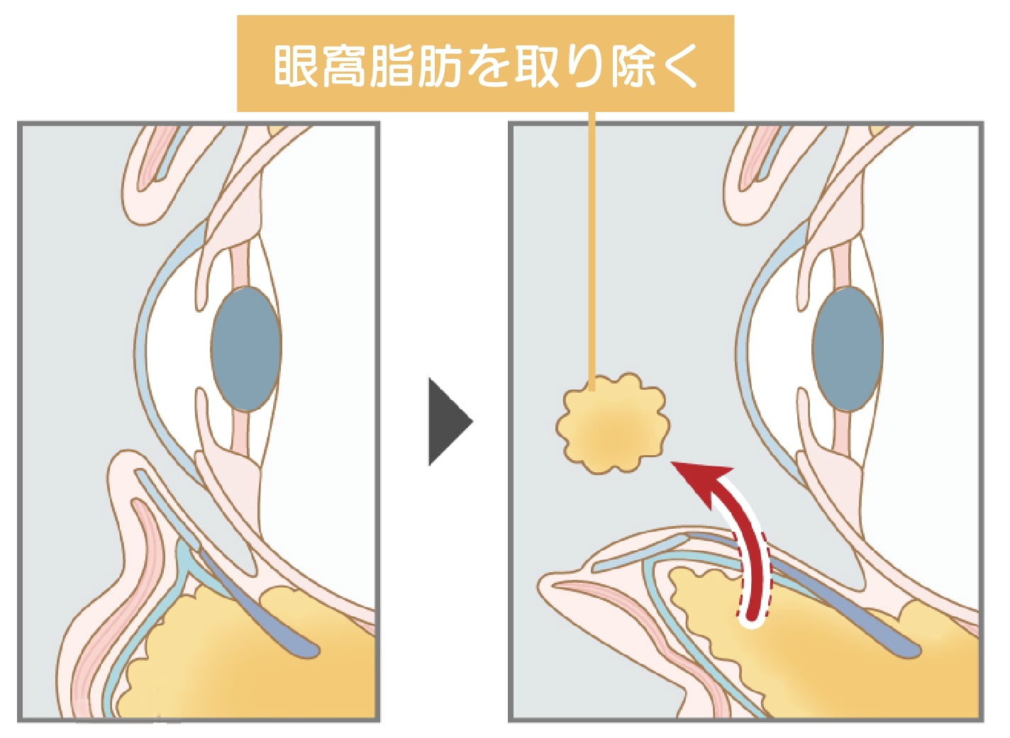 目の下の切らないクマ・たるみ取り