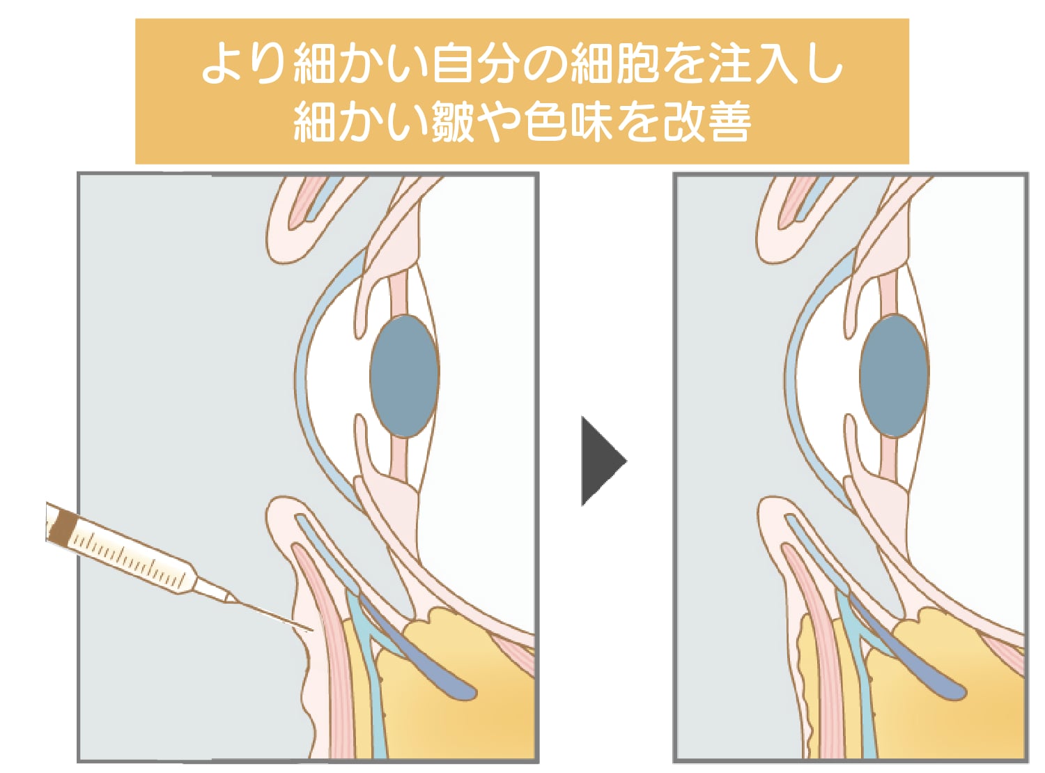 脂肪注入:脂肪注入注射ナノリッチ【色味・小ジワ・窪み改善】