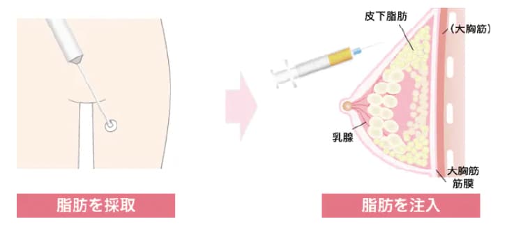 脂肪注入豊胸とは