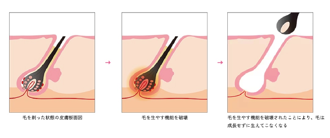 医療レーザー脱毛のメカニズム
