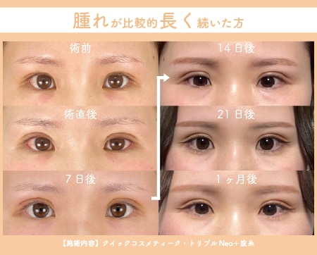 腫れが長く続いた方の例
