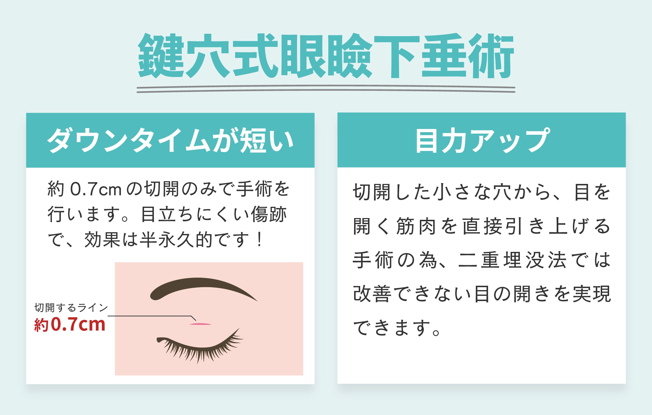 新しい術式「鍵穴式眼瞼下垂術」って?