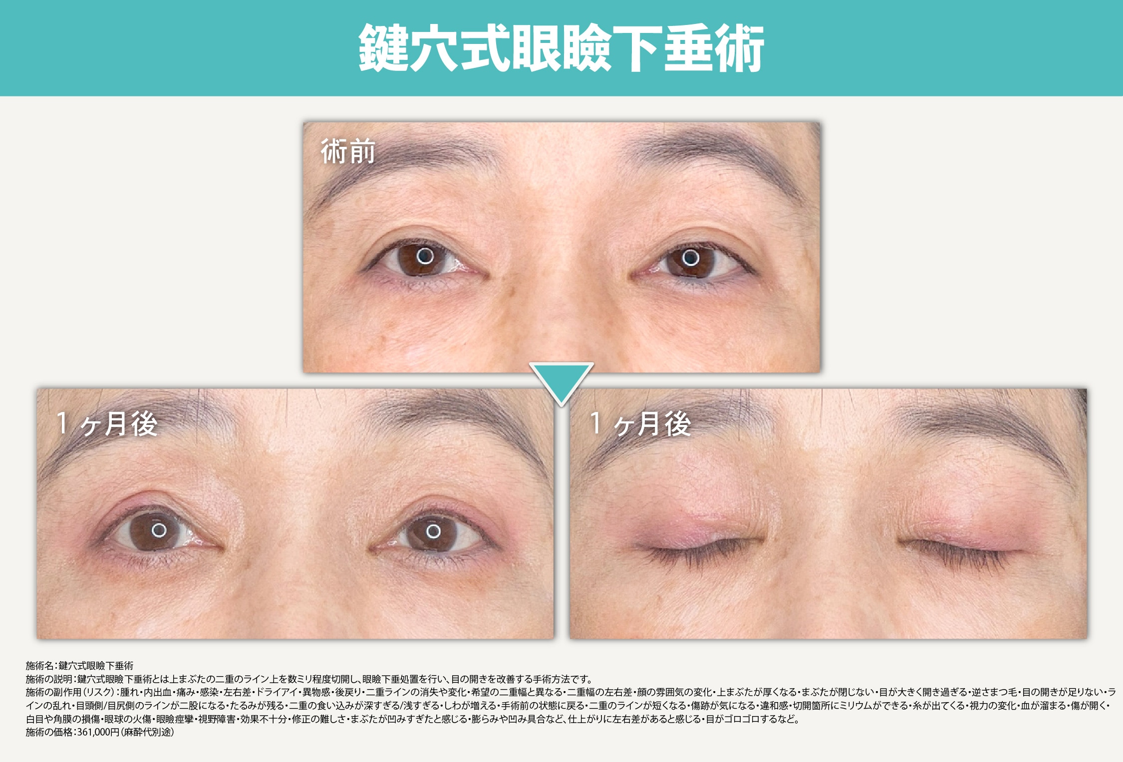 山口医師による鍵穴式眼瞼下垂術